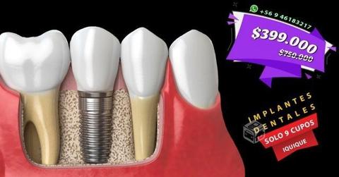Implante dental titanio + corona de porcelana
