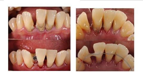 Gingivitis & enfermedad periodontal