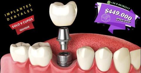 Implante dental titanio mas corona porcelana